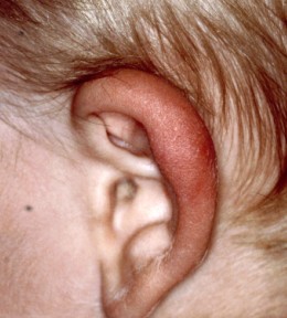 Ohren geschwollene Ohrmuschelentzündungen